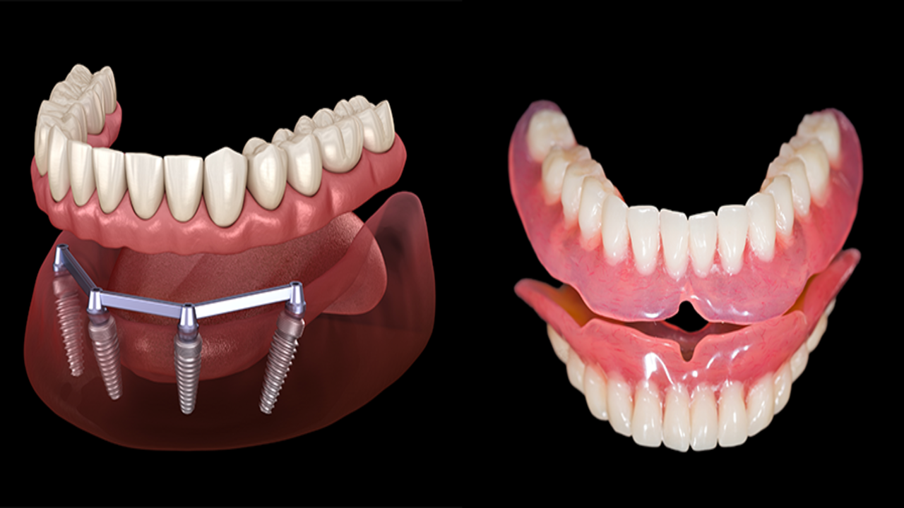 Common Myths About Invisalign: Debunked