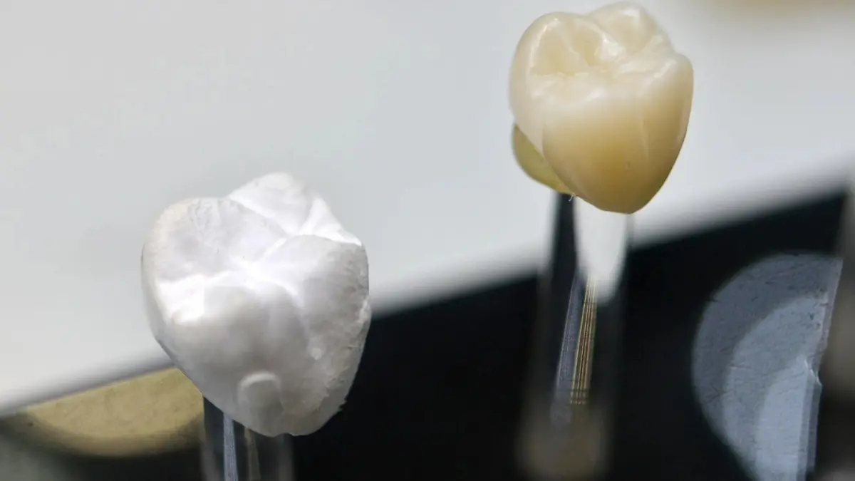 When Do You Need a Dental Crown and How Long Does It Last?