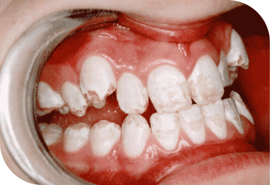 Features of Deep Bite