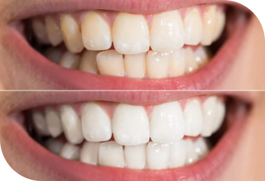 Features of Deep Bite