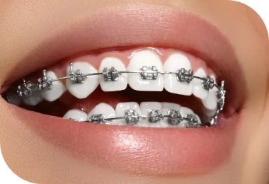 Features of Deep Bite