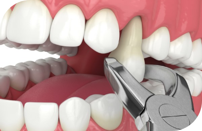 Metal Crowns