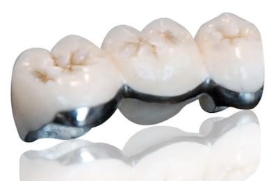Porcelain-Fused-to-Metal (PFM) Crowns