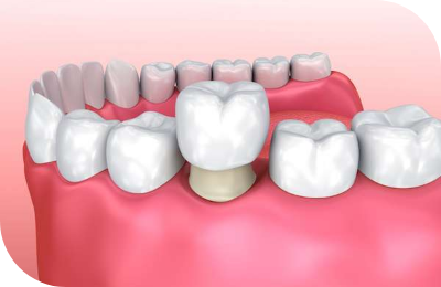 Temporary Crowns