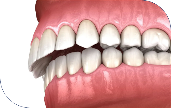 Why Treat Deep Bite?