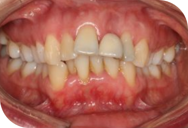 Features of Deep Bite