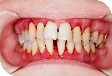 Features of Deep Bite