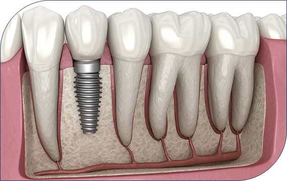 Dental Implants