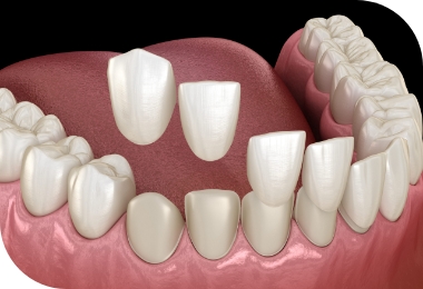 Features of Deep Bite