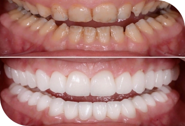 Features of Deep Bite