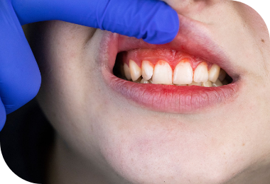 Features of Deep Bite