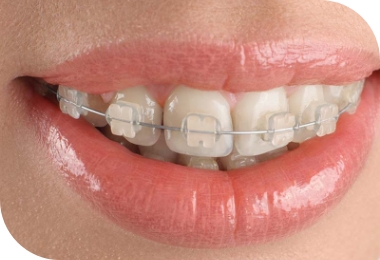 Features of Deep Bite