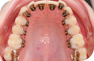 Lingual Braces