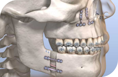 Orthognathic Surgery