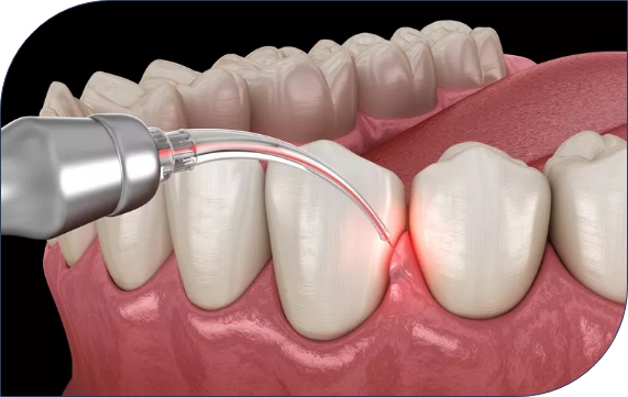 Understanding Deep Bite