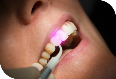 Features of Deep Bite