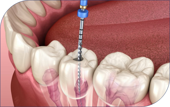 Understanding Deep Bite