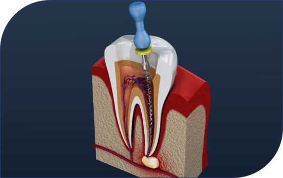 Features of Deep Bite