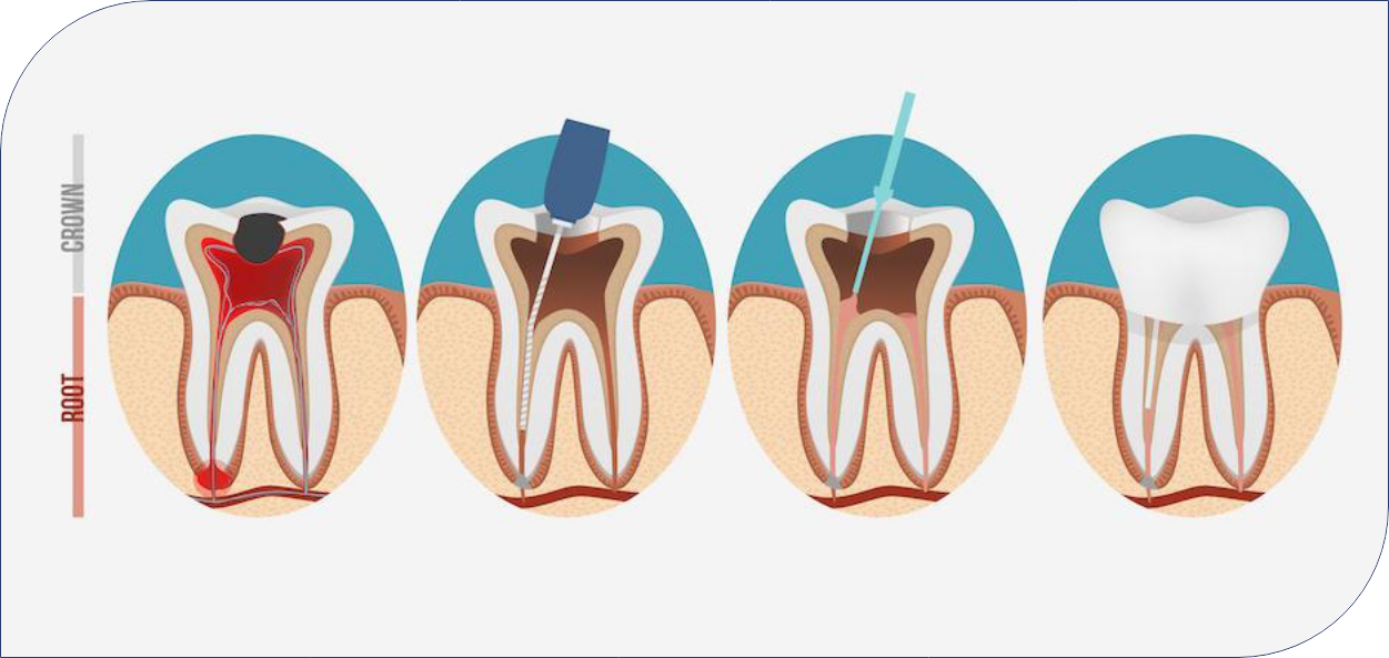 Features of Deep Bite