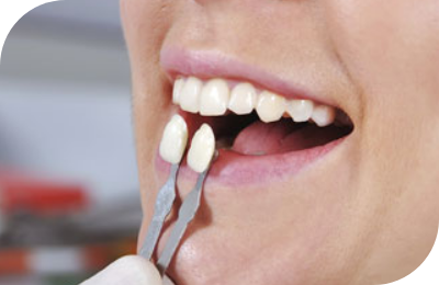 Porcelain Veneers