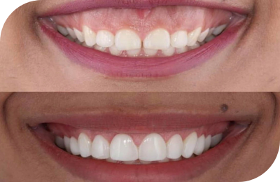 Gum Contouring