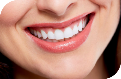 Smile Makeovers