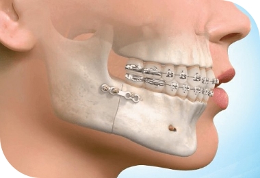 Features of Deep Bite