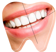 Smile designing