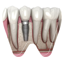 Dental Implants