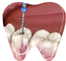 Root Canal Treatment